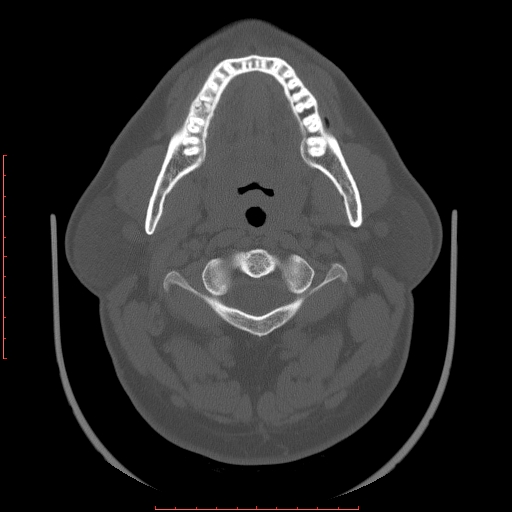 Chronic submandibular sialolithiasis (Radiopaedia 69817-79814 Axial bone window 42).jpg