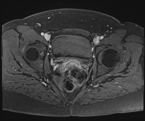 File:Class II Mullerian duct anomaly- unicornuate uterus with rudimentary horn and non-communicating cavity (Radiopaedia 39441-41755 Axial T1 fat sat 94).jpg