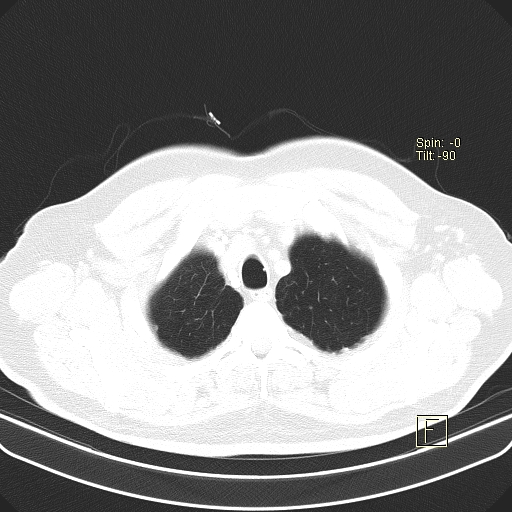 Classic complicated silicosis (Radiopaedia 49720-54961 Axial lung window 5).jpg
