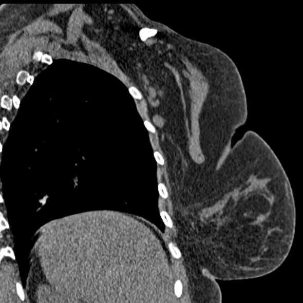 Clear cell chondrosarcoma - humerus (Radiopaedia 63104-71612 Coronal non-contrast 49).jpg
