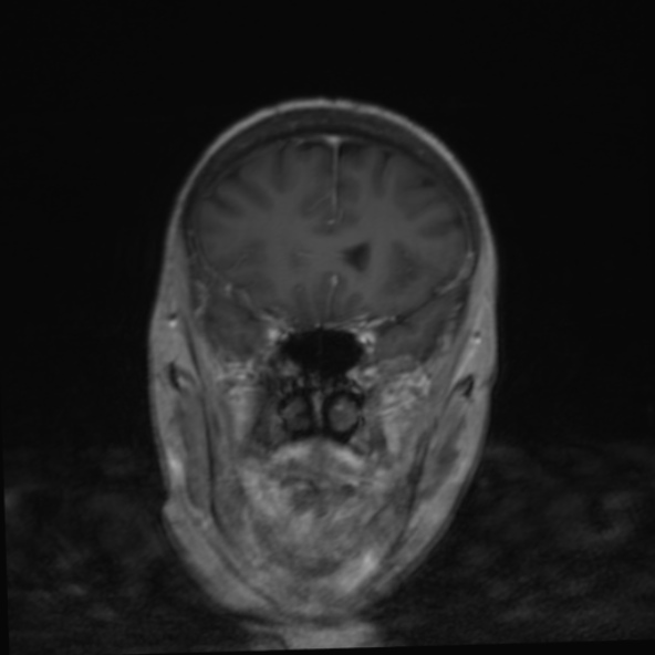 File:Clival meningioma (Radiopaedia 53278-59248 F 10).jpg