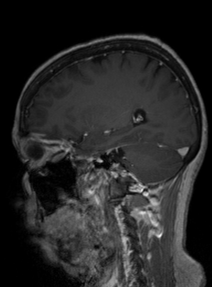 Clival meningioma (Radiopaedia 53278-59248 Sagittal T1 C+ 211).jpg