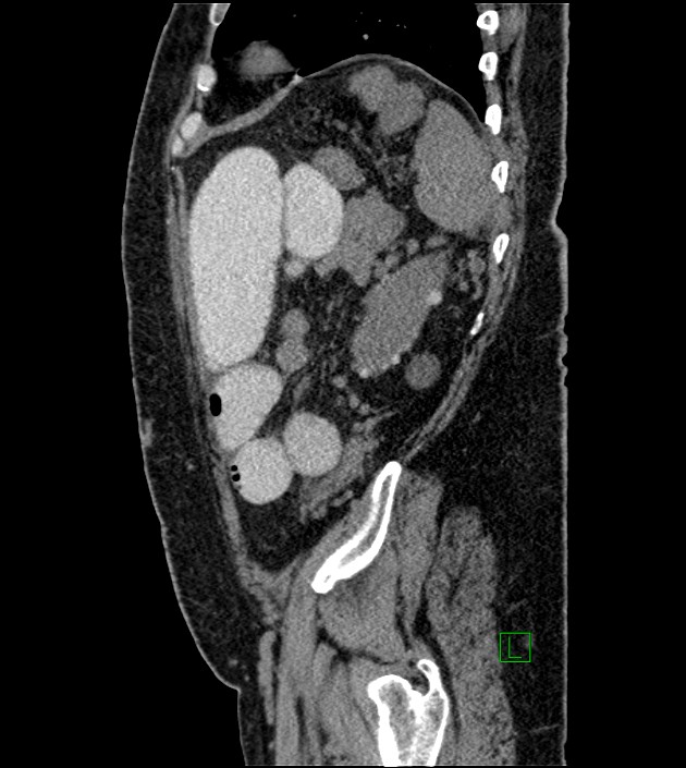 Closed-loop small bowel obstruction-internal hernia (Radiopaedia 78439-91096 C 38).jpg