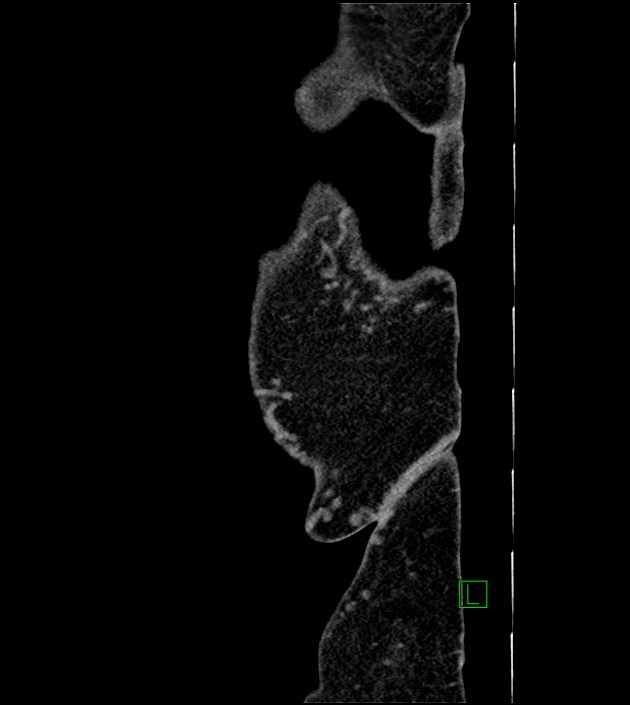 Closed-loop small bowel obstruction-internal hernia (Radiopaedia 78439-91096 C 7).jpg