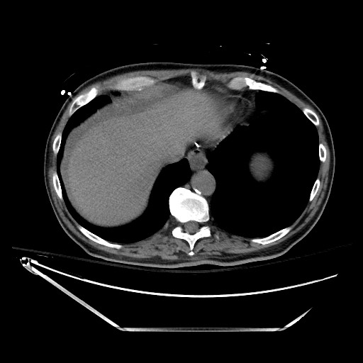 Closed loop obstruction due to adhesive band, resulting in small bowel ischemia and resection (Radiopaedia 83835-99023 Axial non-contrast 24).jpg