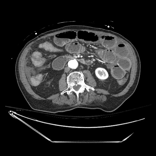 Closed loop obstruction due to adhesive band, resulting in small bowel ischemia and resection (Radiopaedia 83835-99023 B 76).jpg