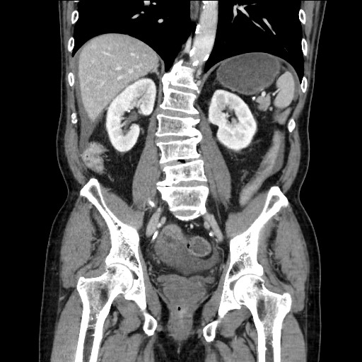 Closed loop obstruction due to adhesive band, resulting in small bowel ischemia and resection (Radiopaedia 83835-99023 E 83).jpg