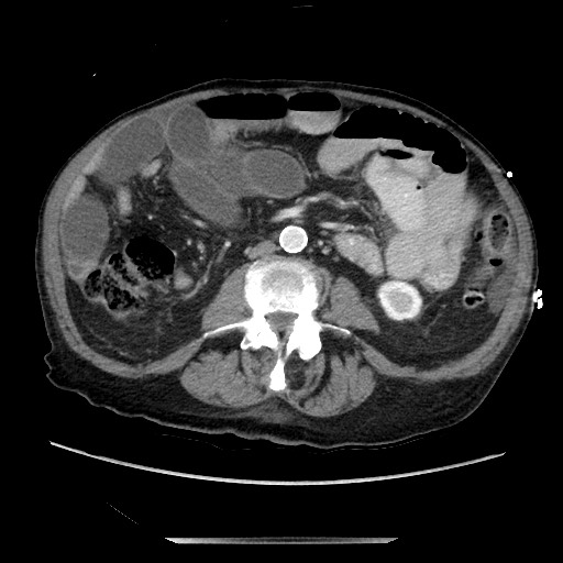 Closed loop small bowel obstruction - adhesive disease and hemorrhagic ischemia (Radiopaedia 86831-102990 A 102).jpg