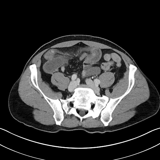 File:Closed loop small bowel obstruction - internal hernia (Radiopaedia 57806-64778 B 90).jpg
