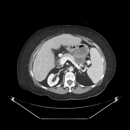 File:Closed loop small bowel obstruction - internal hernia (Radiopaedia 65402-74450 A 38).jpg