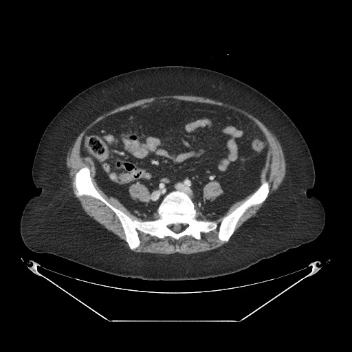 Closed loop small bowel obstruction - internal hernia (Radiopaedia 65402-74450 A 89).jpg