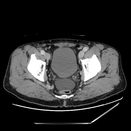 Closed loop small bowel obstruction - omental adhesion causing "internal hernia" (Radiopaedia 85129-100682 A 153).jpg