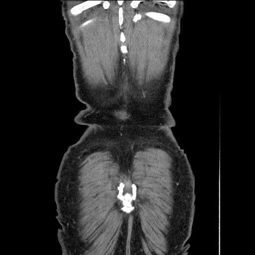 Closed loop small bowel obstruction - omental adhesion causing "internal hernia" (Radiopaedia 85129-100682 B 121).jpg