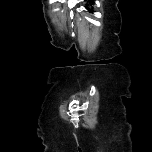 File:Closed loop small bowel obstruction due to adhesive band, with intramural hemorrhage and ischemia (Radiopaedia 83831-99017 C 114).jpg