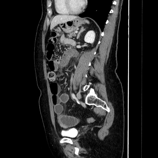 Closed loop small bowel obstruction due to adhesive bands - early and late images (Radiopaedia 83830-99015 C 110).jpg