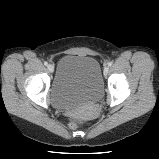 File:Closed loop small bowel obstruction due to trans-omental herniation (Radiopaedia 35593-37109 A 79).jpg