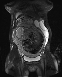 File:Closed loop small bowel obstruction in pregnancy (MRI) (Radiopaedia 87637-104031 Coronal T2 fat sat 20).jpg
