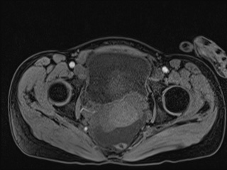 File:Closed loop small bowel obstruction in pregnancy (MRI) (Radiopaedia 87637-104031 G 16).jpg