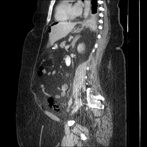 File:Collection due to leak after sleeve gastrectomy (Radiopaedia 55504-61972 C 31).jpg