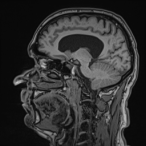 File:Colloid cyst of the third ventricle (Radiopaedia 86571-102662 Sagittal T1 45).png
