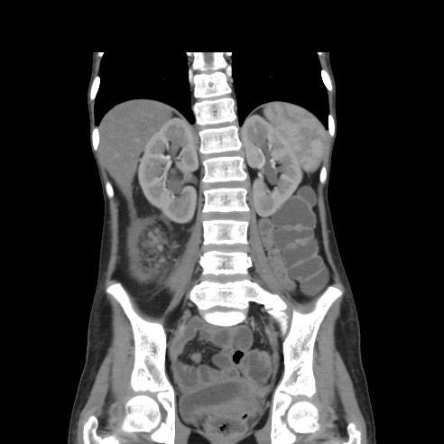 File:Colocolic fistula - Crohn disease (Radiopaedia 57063-63955 B 30).jpg