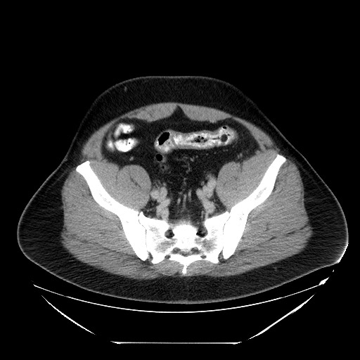 Colocolic intussusception due to lipoma (Radiopaedia 73712-84508 A 93).jpg