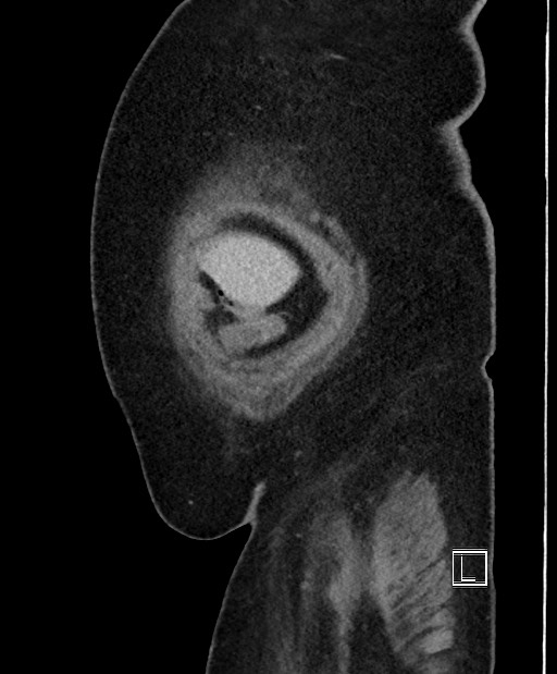 Colon adenocarcinoma (Radiopaedia 59374-66735 C 62).jpg