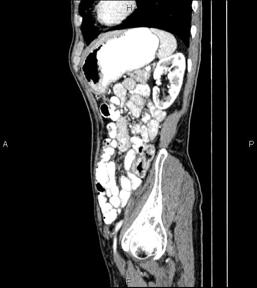 Colon adenocarcinoma - hepatic flexure (Radiopaedia 85635-101395 D 68).jpg