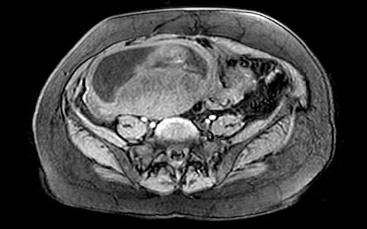 Colon adenocarcinoma with Krukenberg tumors, advanced pregnancy (Radiopaedia 67279-76645 A 29).jpg