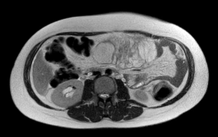 Colon adenocarcinoma with Krukenberg tumors, advanced pregnancy (Radiopaedia 67279-76645 Axial T2 46).jpg