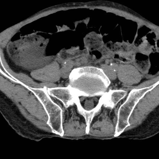 File:Colon cancer with calcified liver metastasis (Radiopaedia 74423-85309 Axial non-contrast 79).jpg