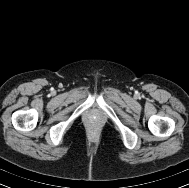 Colon carcinoma with hepatic metastases (Radiopaedia 29477-29961 A 123).jpg