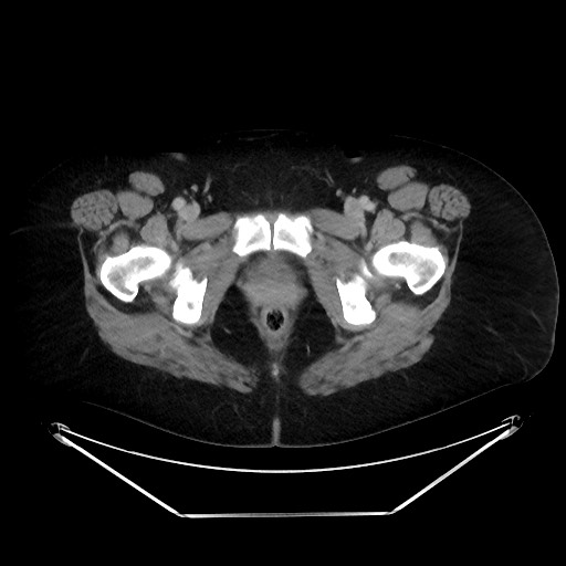 File:Colonic intussusception due to adenocarcinoma (Radiopaedia 86828-102987 A 149).jpg