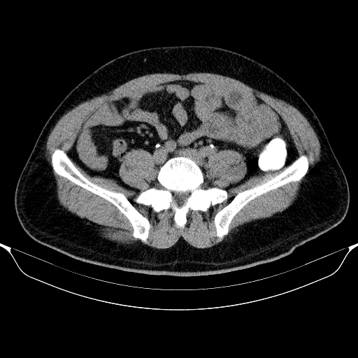 File:Colonic lipoma with colo-colic intussusception (Radiopaedia 58944-66200 Axial 88).jpg