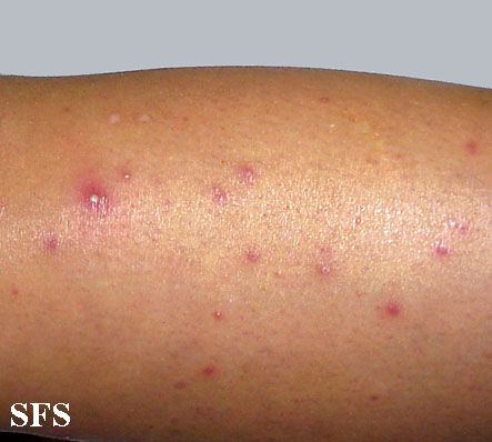 File:Folliculitis (Dermatology Atlas 5).jpg