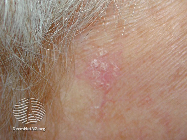 File:Intraepidermal carcinoma (DermNet NZ lesions-scc-in-situ-2928).jpg