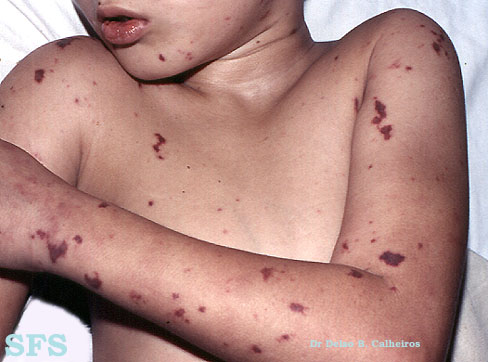 File:Meningitis (Dermatology Atlas 2).jpg