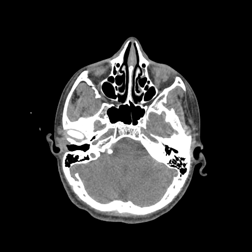 Nasal pyogenic granuloma (lobular capillary hemangioma) (Radiopaedia 85536-101244 Axial non-contrast 79).jpg