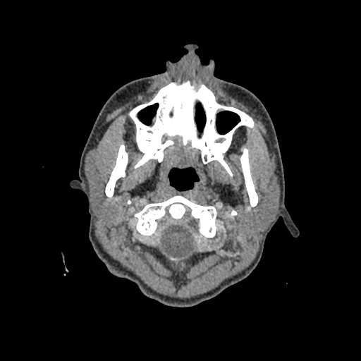 File:Nasal pyogenic granuloma (lobular capillary hemangioma) (Radiopaedia 85536-101244 C 5).jpg