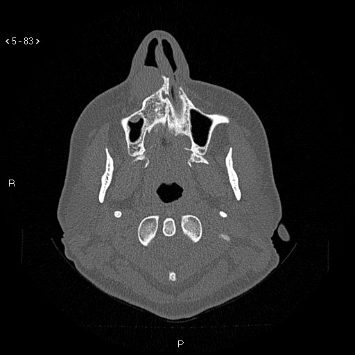 Nasolabial cyst (Radiopaedia 75125-86194 Axial bone window 44).jpg