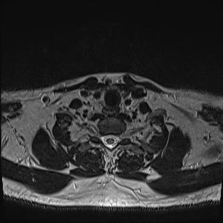 Nasopharyngeal carcinoma with perineural spread (Radiopaedia 55030-61380 Axial T2 79).jpg