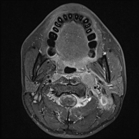 Nasopharyngeal carcinoma with skull base invasion (Radiopaedia 53415-59485 Axial T1 C+ fat sat 37).jpg