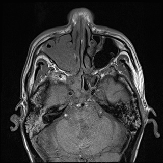 Nasopharyngeal carcinoma with skull base invasion (Radiopaedia 59258-66600 B 13).jpg