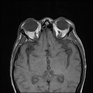 Nasopharyngeal carcinoma with skull base invasion (Radiopaedia 59258-66600 B 3).jpg