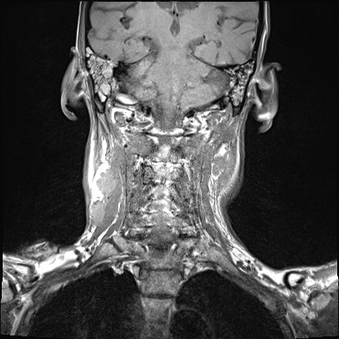 File:Nasopharyngeal carcinoma with skull base invasion (Radiopaedia 59258-66600 Coronal T1 7).jpg