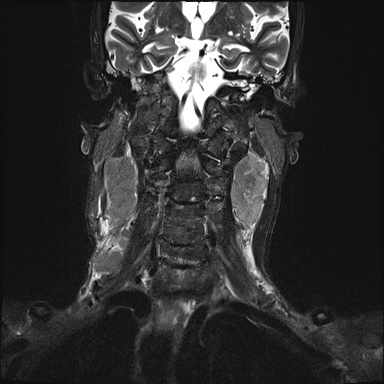 Nasopharyngeal carcinoma with skull base invasion (Radiopaedia 59258-66600 Coronal T2 fat sat 12).jpg