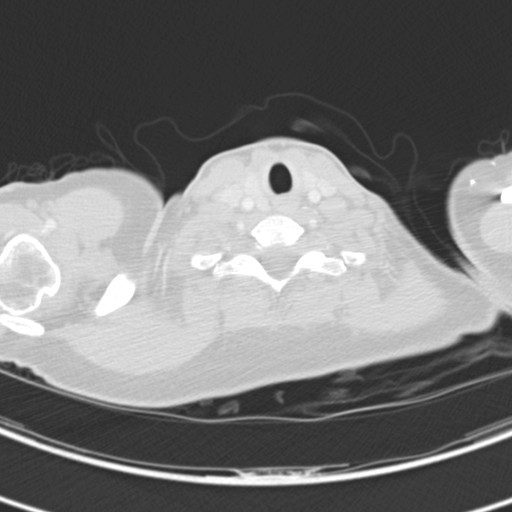 Necrobiotic pulmonary nodules - Crohn disease (Radiopaedia 20723-20631 Axial lung window 4).jpg