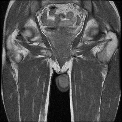 File:Necrotizing epididymo-orchitis with intra-testicular abscess (Radiopaedia 29397-29860 Coronal T1 C+ 17).jpg