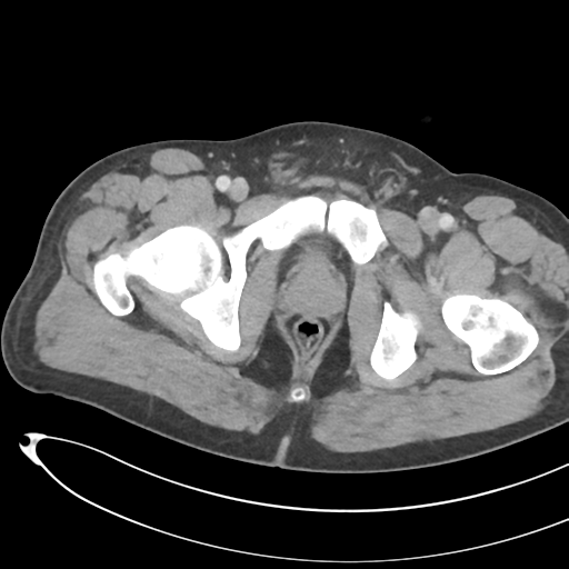 File:Necrotizing pancreatitis with acute necrotic collections (Radiopaedia 38829-41012 B 85).png
