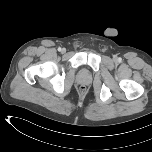 File:Necrotizing pancreatitis with acute necrotic collections (Radiopaedia 38829-41012 B 86).png
